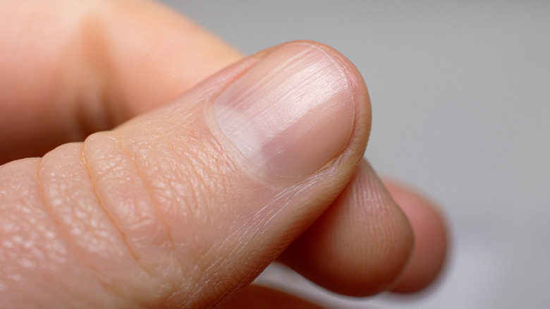 What Do Those Ridges In Your Nails Mean?