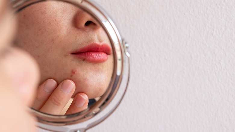 Person inspecting zit in mirror