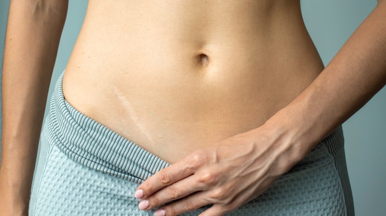 Surgical scar on female body