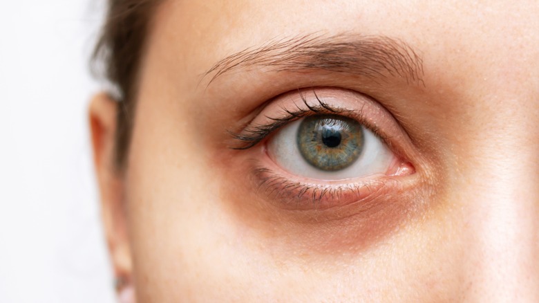 Closeup woman undereye circles