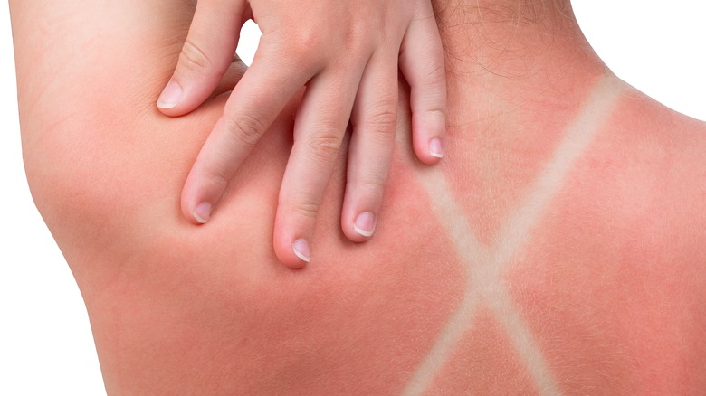 back sunburn