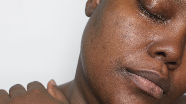 The Difference Between Melasma and Other Skin Spots