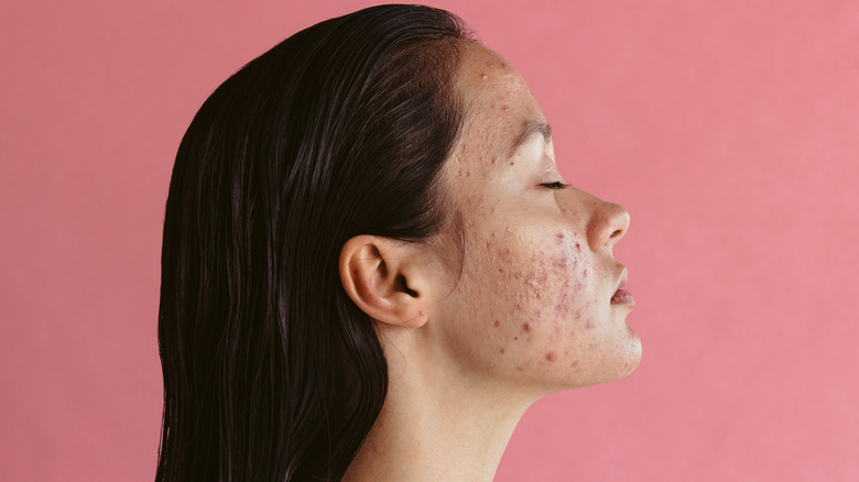 Profile of woman with acne