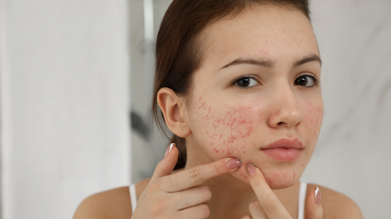 Woman picking at acne on face