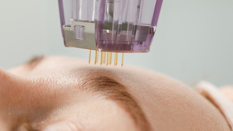 Forehead with microneedling tool