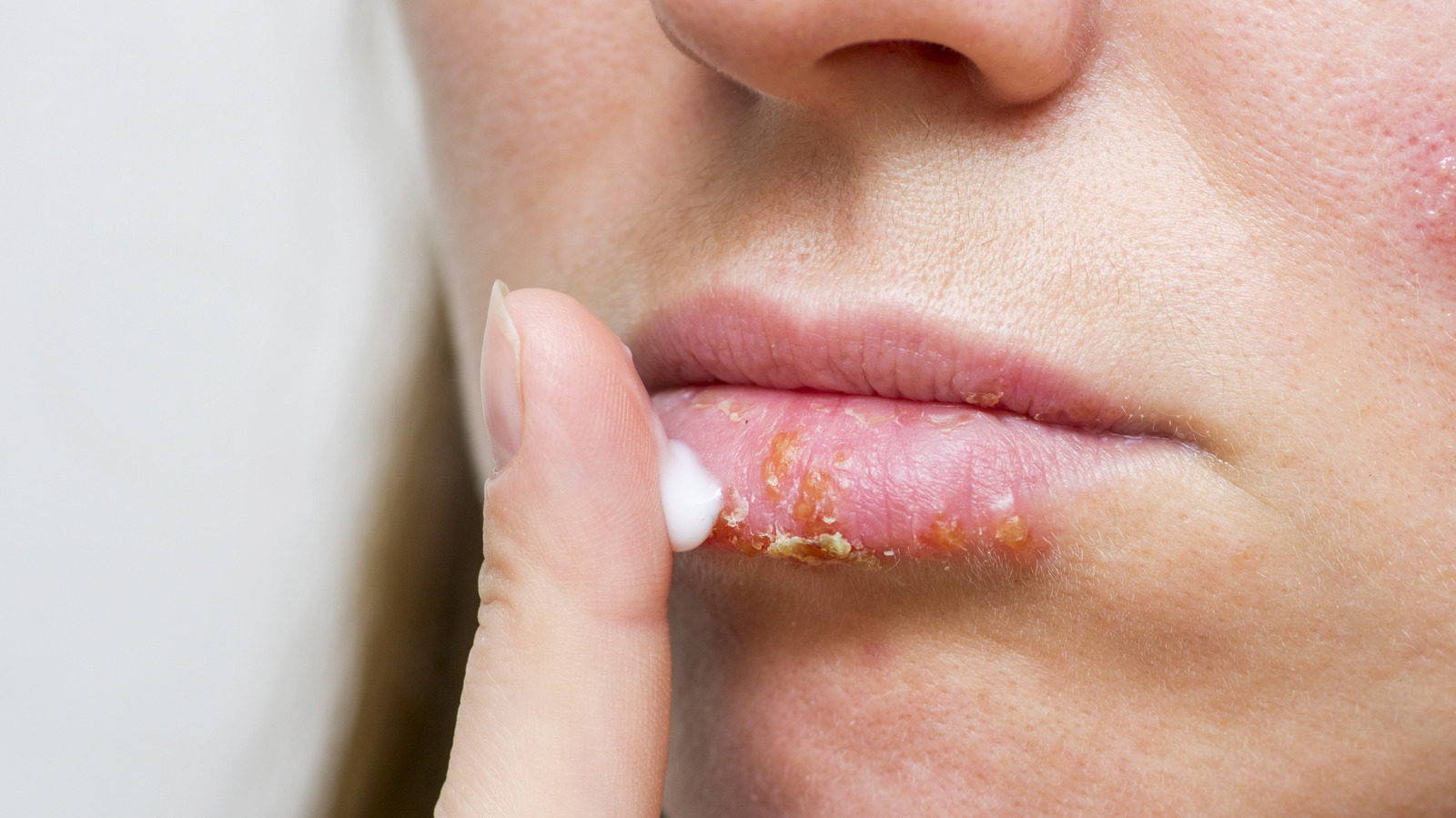 Is It Chapped Lips Or A Cold Sore Heres How To Tell And How To Treat