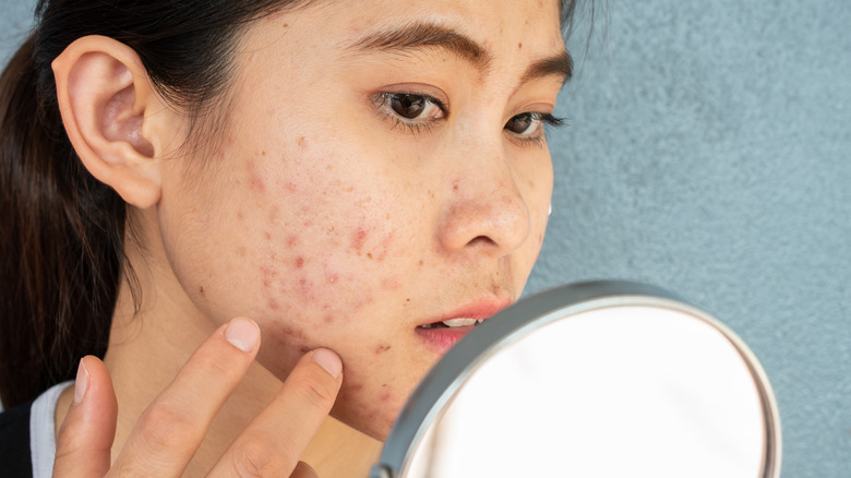 acne outbreak on face