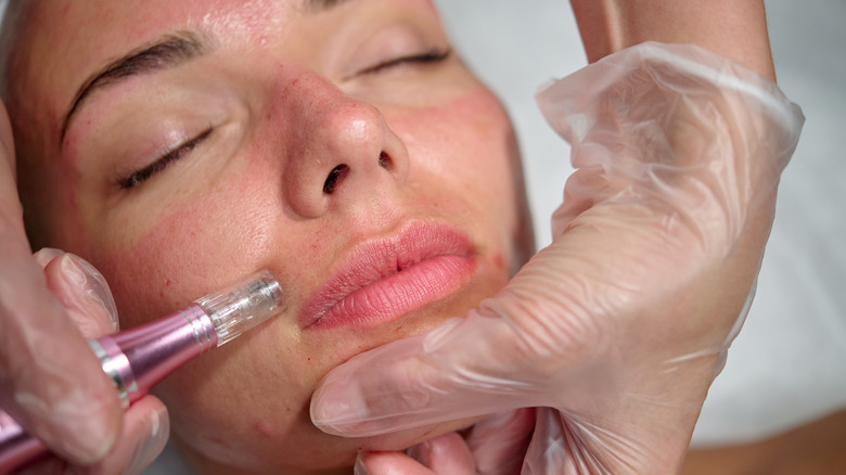 Microneedling lips