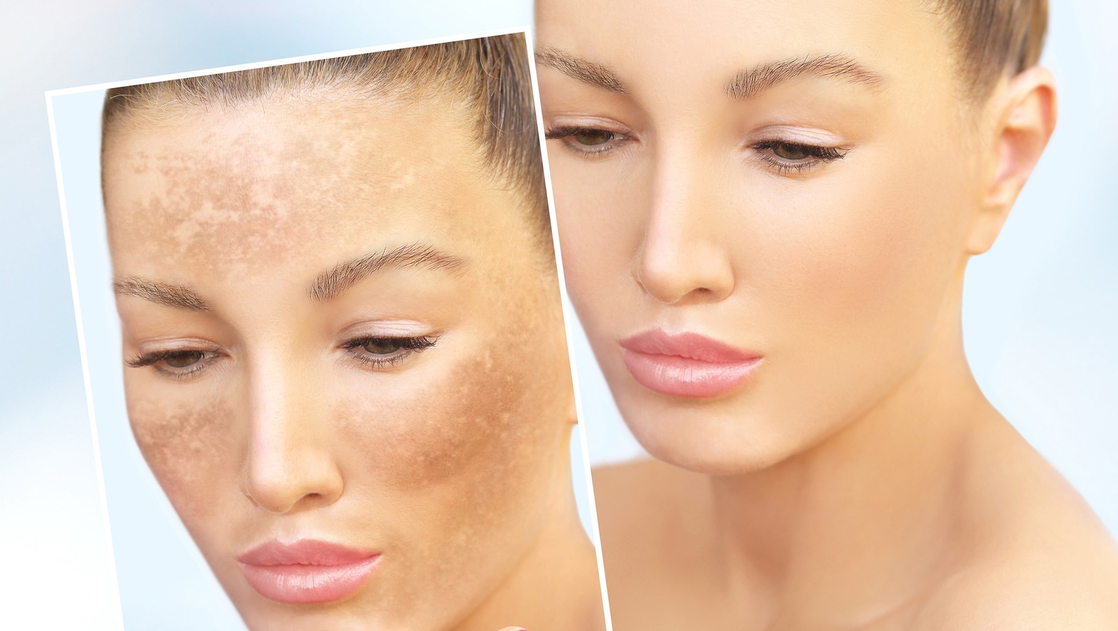 Body Hyperpigmentation What Is It And Why Does It Happen?