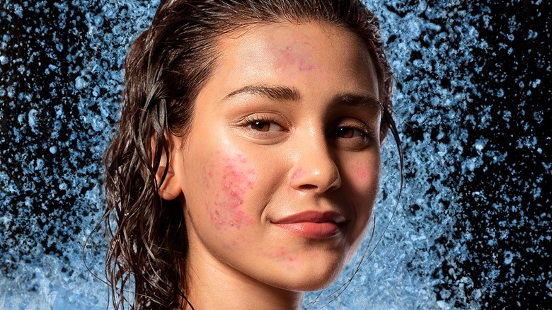 Girl with acne