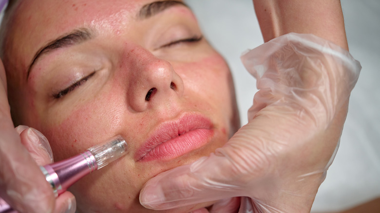 a woman having microneedling done