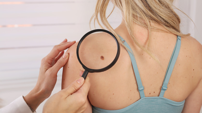 Woman getting mole examined