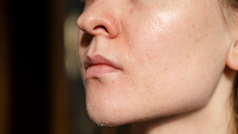 woman with peeling red skin