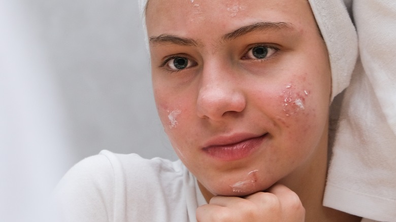 female having acne