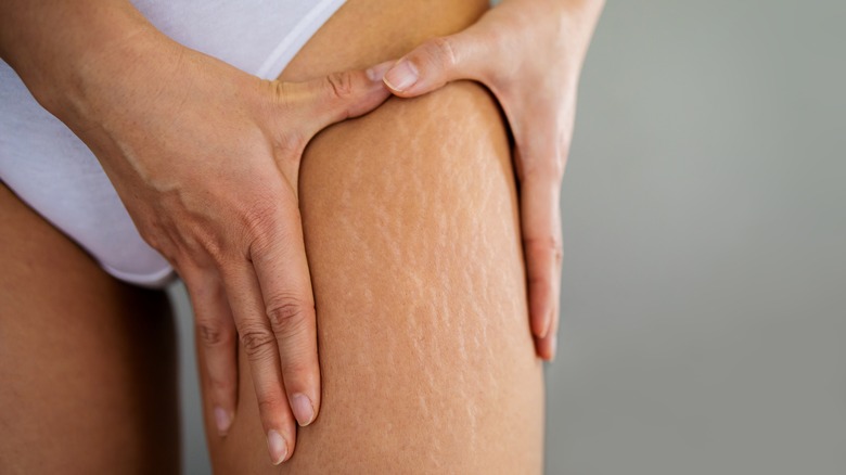 white stretch marks on thigh