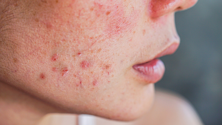 woman with facial acne