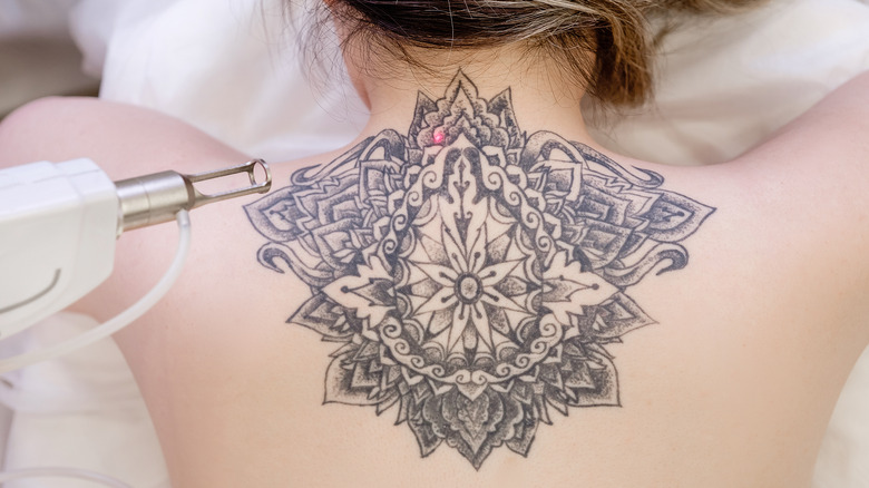 laser tattoo removal on back
