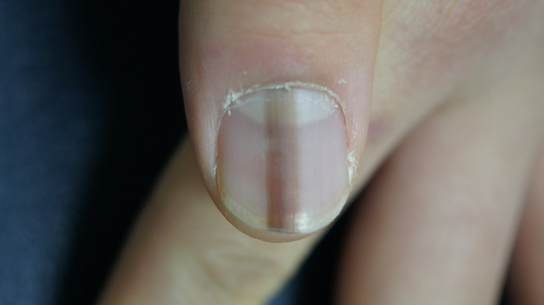 Why Are My Nails Peeling? - 9 Causes of Flaking, Peeling Nails
