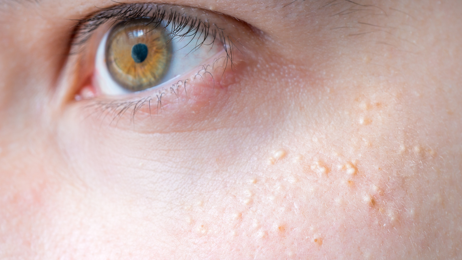 Fordyce Spots Vs. Milia What's The Difference?