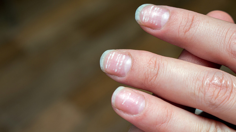 What are half moons on nails? - RemoteDerm