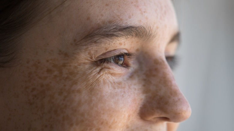 freckled on a person's face