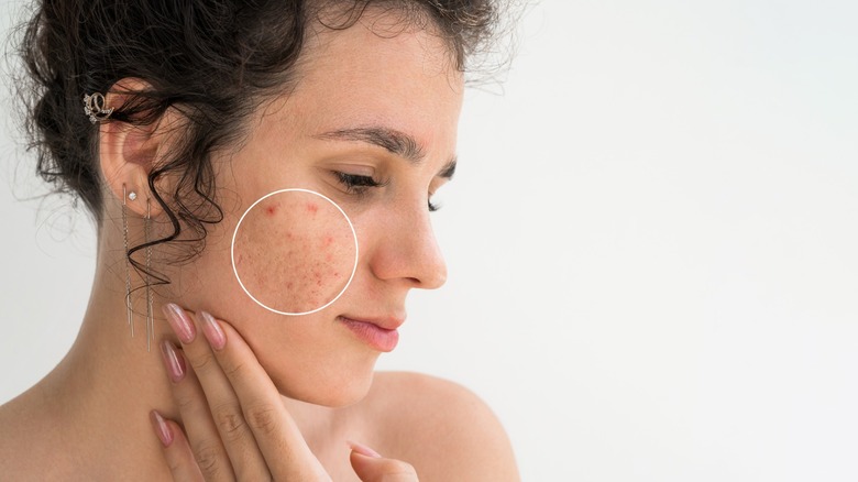 A woman with minor acne on her cheek.