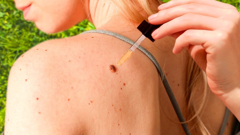 Tea tree oil on skin tag