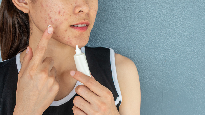acne treatment