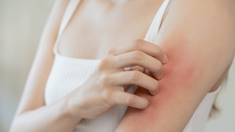 Woman scratching irritated arm