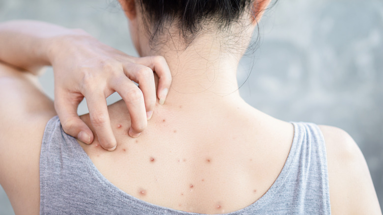 woman scratching her back acne