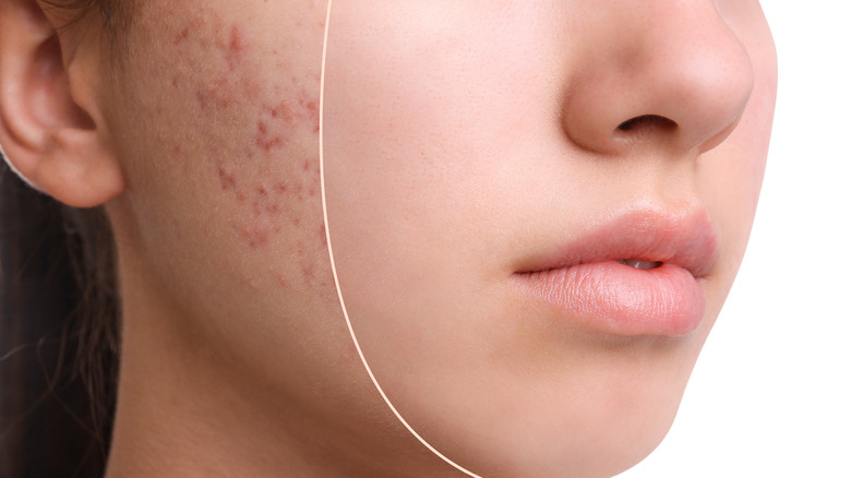 young woman treating her acne
