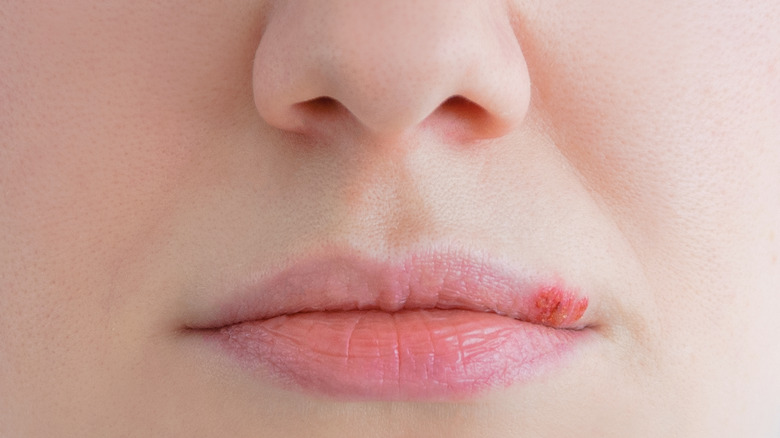 Cold sore on lip