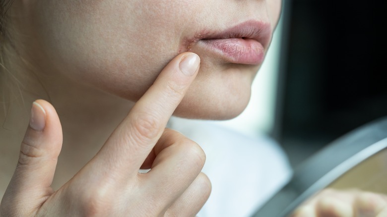 Cold sore on lip