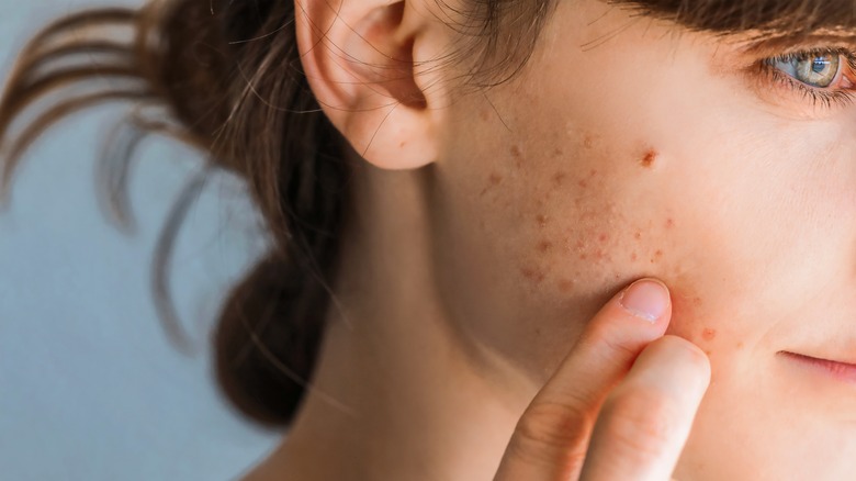 woman with acne on cheek