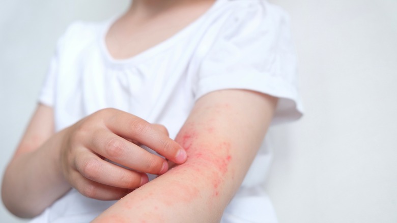 Girl with a rash
