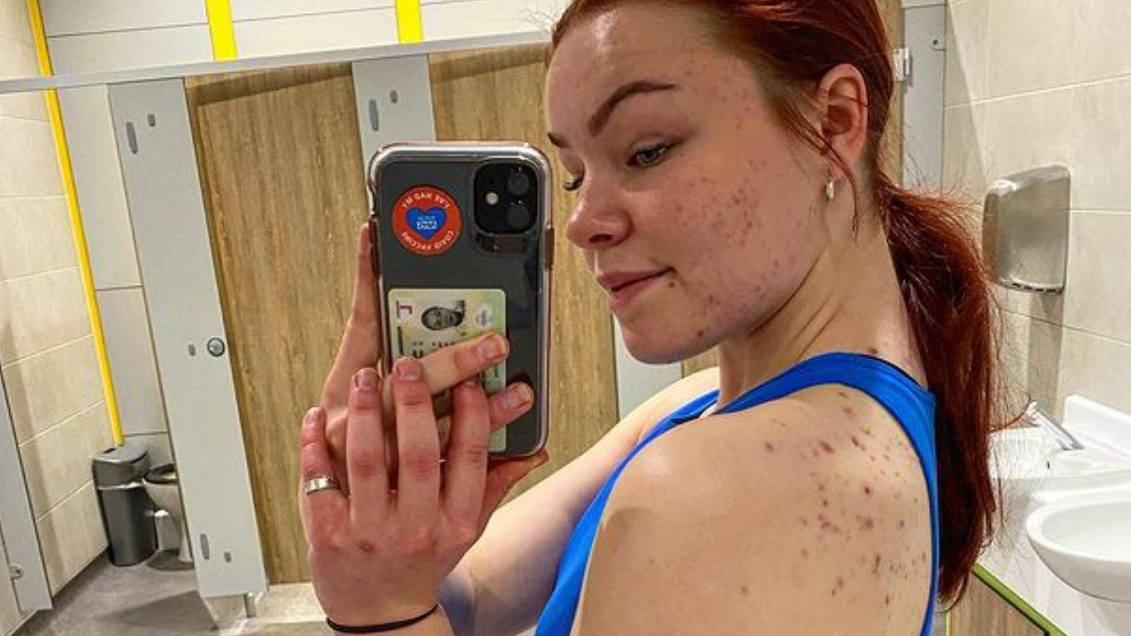 How To Seamlessly Cover Up Body Acne With Concealer