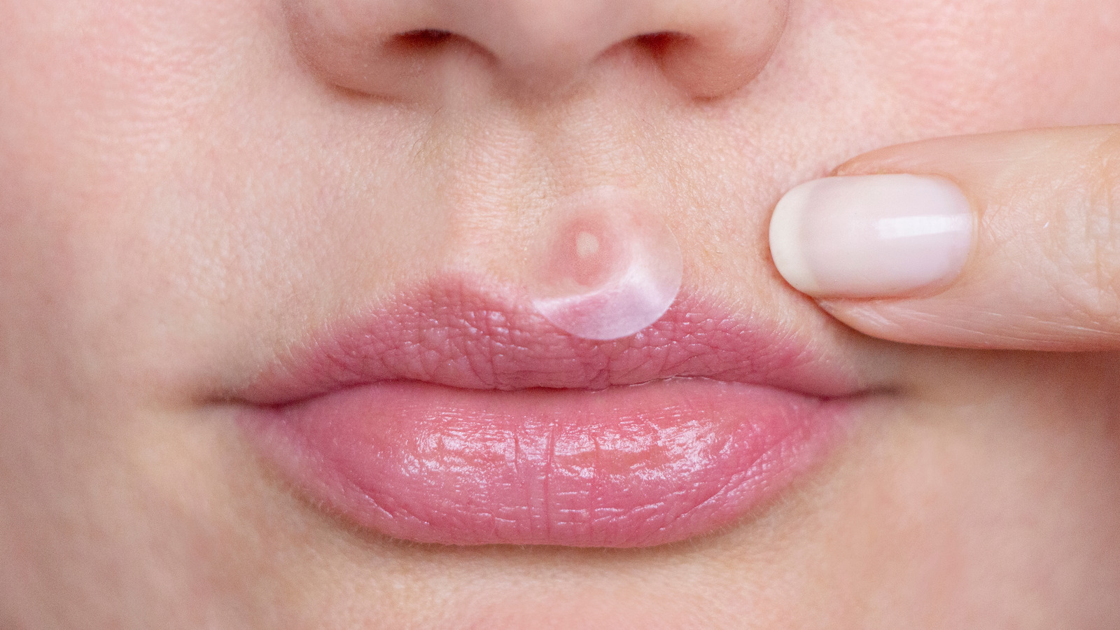 Acne best sale around mouth