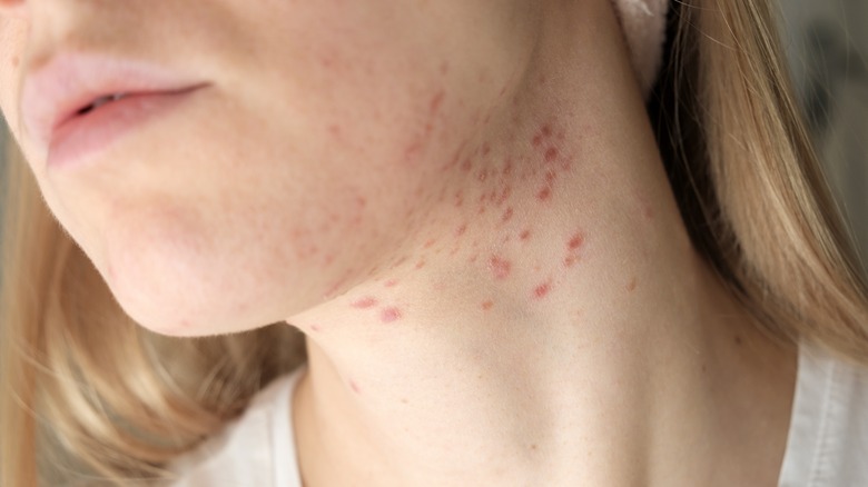 close up of neck acne