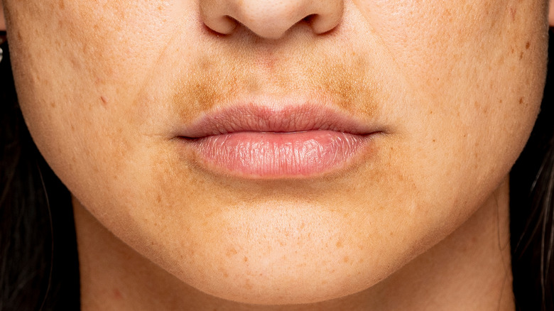 woman with hyperpigmentation on face