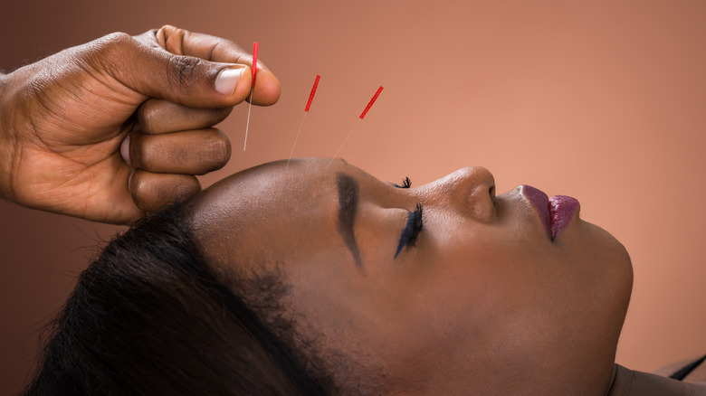 Woman receiving facial acupuncture