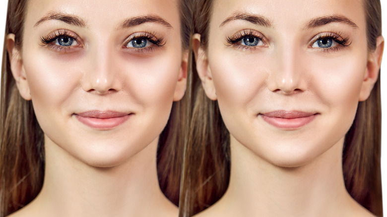 under eye before after treatment