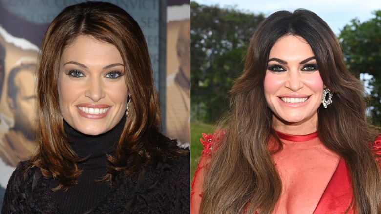 A before and after photo showing Kimberly Guilfoyle's facial transformation