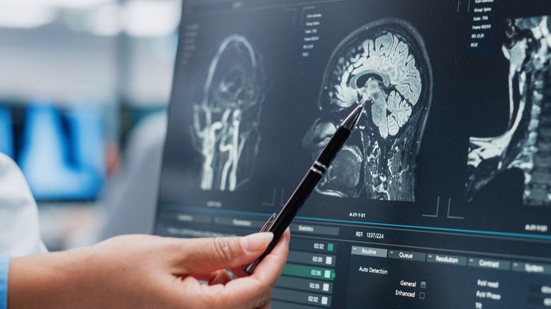 pen pointing at brain scan