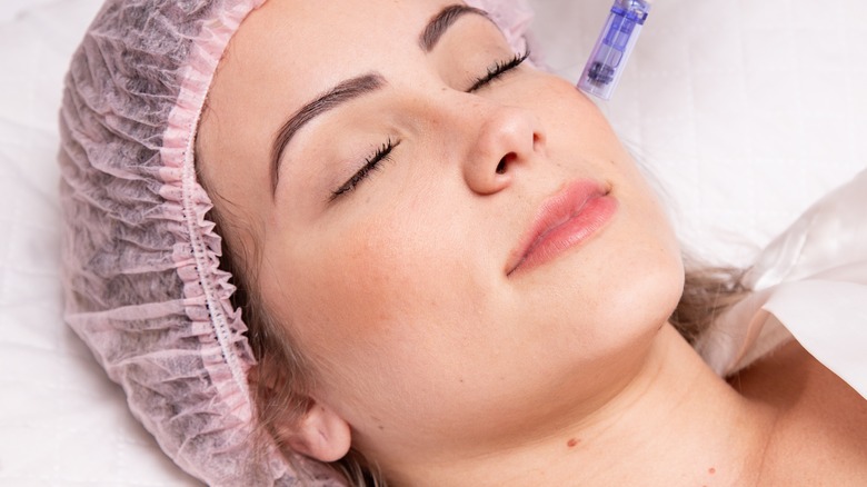 microneedling