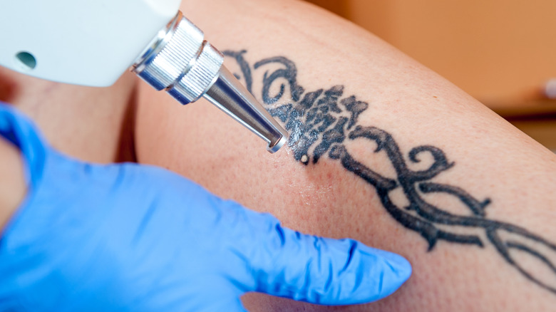 A person getting a tribal tattoo laser removed from their leg