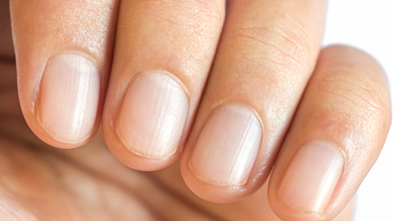 woman with nail psoriasis