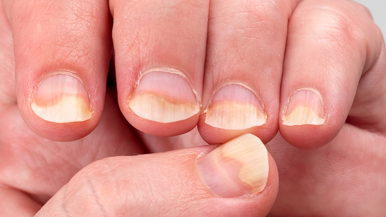 Nail Psoriasis: You Can't Cure Nail Psoriasis, But These Treatment Options  Might Help | Glamour