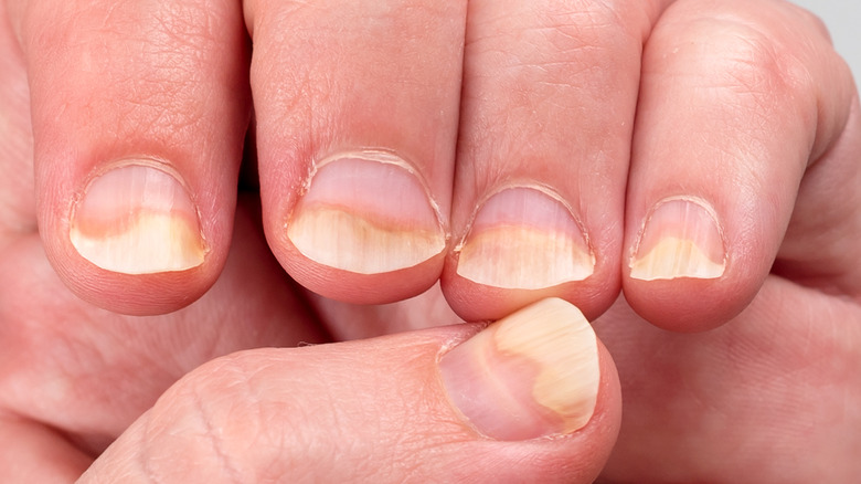 Nail Disorders - Dr. Vishal Chadha