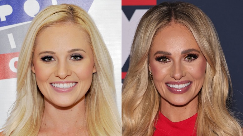 ﻿Tomi Lahren posing for a photo in 2017 before plastic surgery rumors versus﻿ ﻿Tomi Lahren posing for a photo in 2025