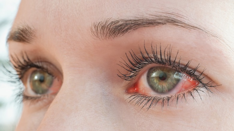 person with irritated eyes